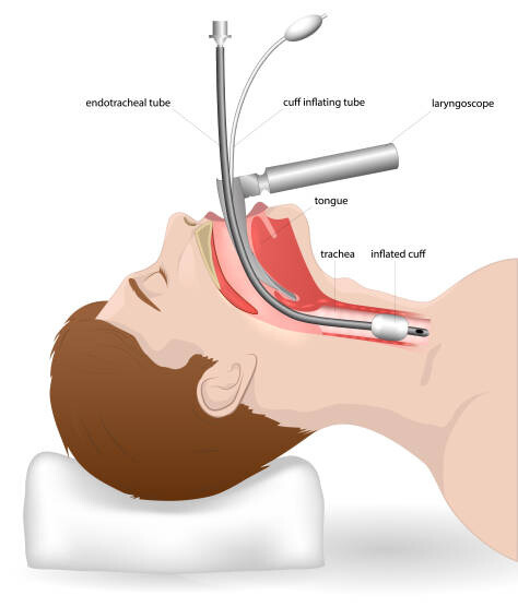 endotracheal tube