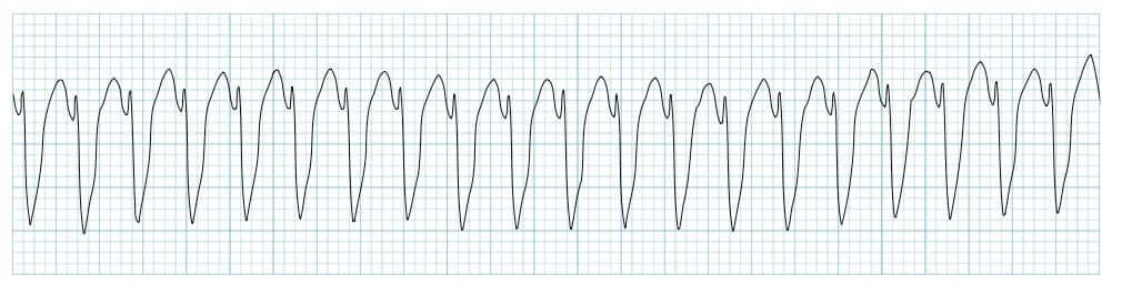 Pulseless Ventricular Tachycardia (VTach):