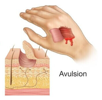 Avulsions