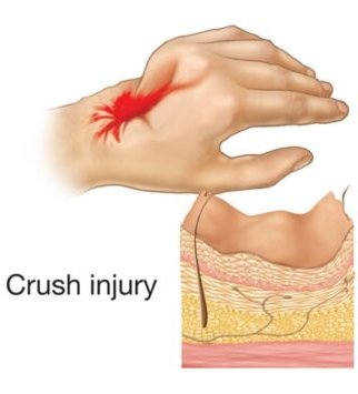 Crush Injuries
